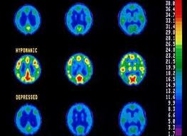 Prefrontal-limbic Network Dysfunction in Depressive BD